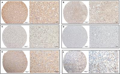 CHI3L2 Is a Novel Prognostic Biomarker and Correlated With Immune Infiltrates in Gliomas